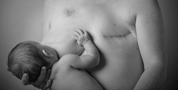 Breast Cancer Patients